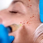 plasma-therapy-skin-2-min